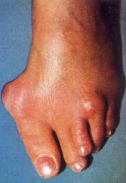ce este artrita la picior