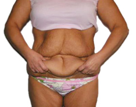 ovarele polichistice pot împiedica pierderea în greutate slimdoo minceur brățară