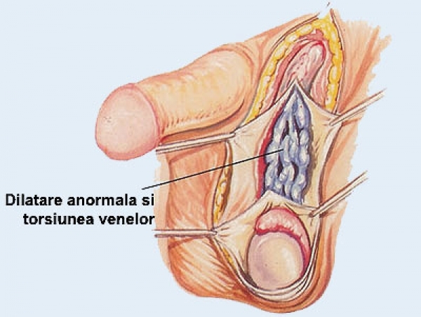 există o erecție după operația de prostată penisul crește brusc